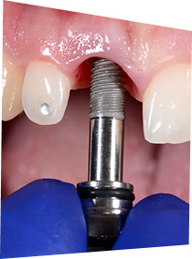 Implants dentaires