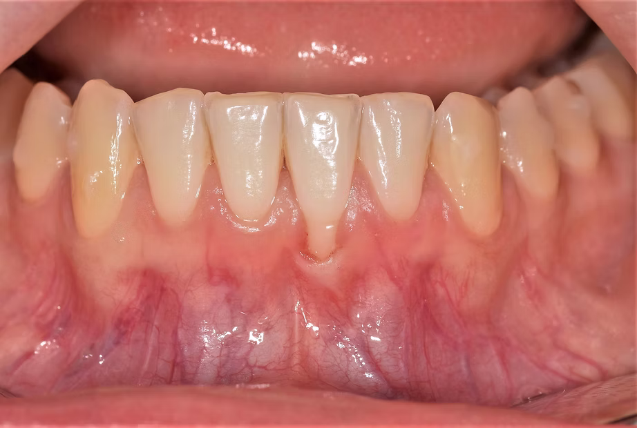 Esthétique dentaire par greffe de gencives 