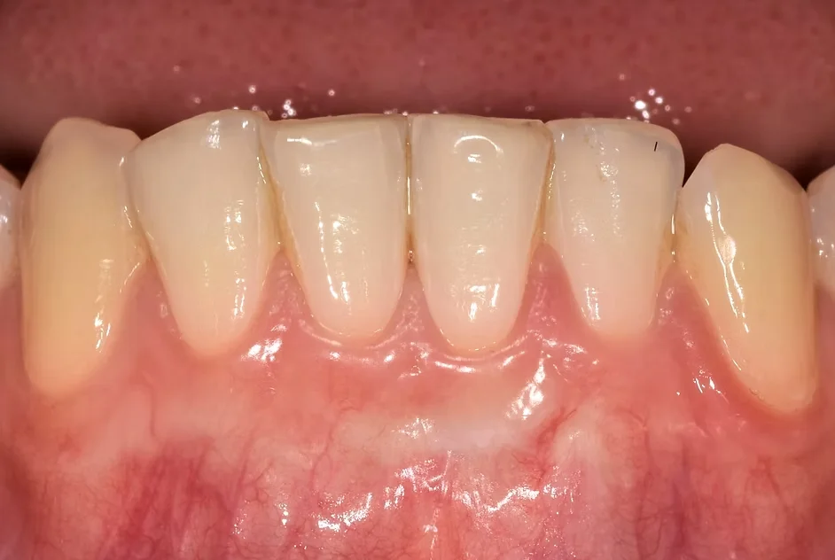 Esthétique dentaire par greffe de gencives&nbsp;